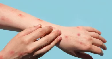 Brasil chega a 140 casos confirmados de mpox em 2026