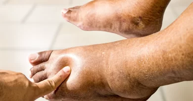 Corpo inchado? Pode ser mais sério do que parece!