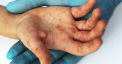 SP confirma segundo caso importado de sarampo