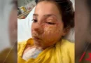 Menina de 10 anos sofre queimaduras no rosto após fazer desafio do TikTok