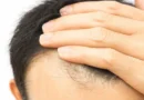 Cabelo transplantado pode cair? Veja alguns detalhes sobre o procedimento