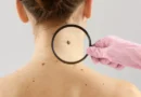 Câncer: estudo alerta para riscos de melanoma fora da pele