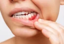 Retração gengival: por que a gengiva se afasta dos dentes e como prevenir