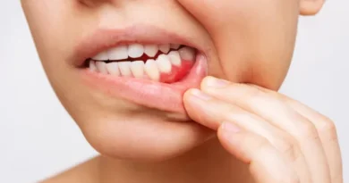 Retração gengival: por que a gengiva se afasta dos dentes e como prevenir
