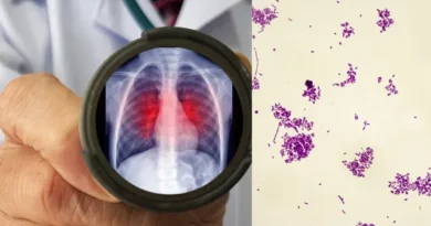 Peste pneumônica: o que é, os riscos e como se transmite esta infecção