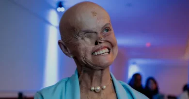 Brasileira sobreviveu a 73 cânceres de pele; agora aguarda por cirurgia